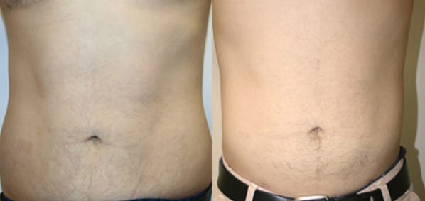 Liposuction Before & After - Dr. Thomassen