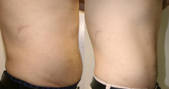 Liposuction Before & After - Dr. Thomassen