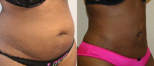 Liposuction Before & After - Dr. Thomassen