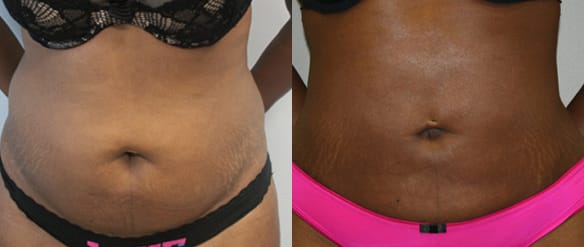 Liposuction Before & After - Dr. Thomassen