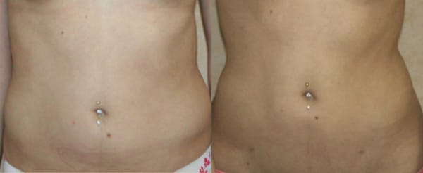 Liposuction Before & After - Dr. Thomassen