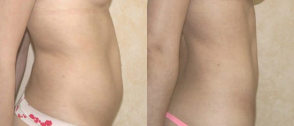 Liposuction Before & After - Dr. Thomassen