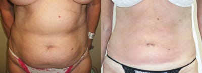 Liposuction Before & After - Dr. Thomassen