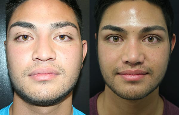 Rhinoplasty Before & After - Dr. Thomassen