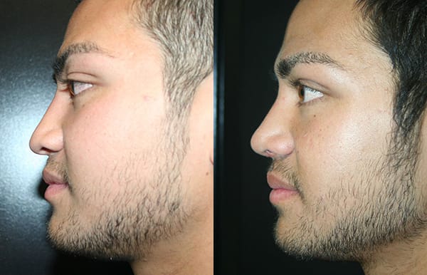 Rhinoplasty Before & After - Dr. Thomassen