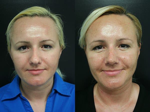 Rhinoplasty Before & After - Dr. Thomassen
