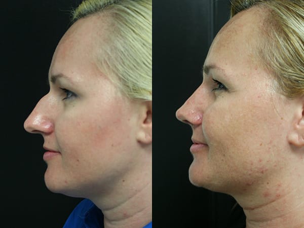 Rhinoplasty Before & After - Dr. Thomassen
