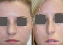 Rhinoplasty Before & After - Dr. Thomassen