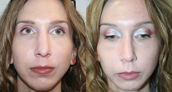 Rhinoplasty Before & After - Dr. Thomassen