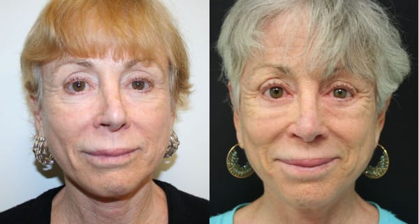 Rhinoplasty Before & After - Dr. Thomassen