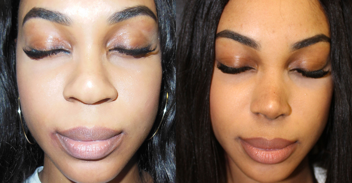 Rhinoplasty Before & After - Dr. Thomassen