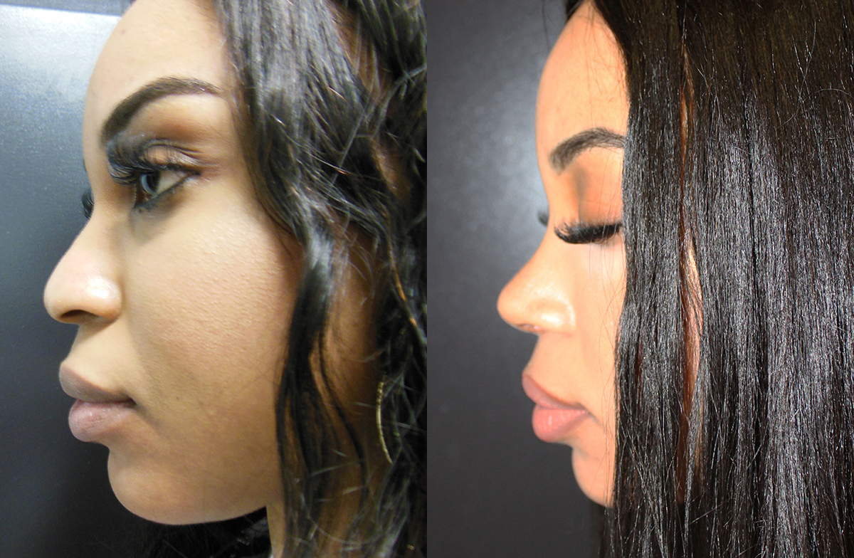 Rhinoplasty Before & After - Dr. Thomassen