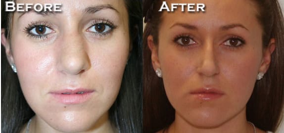 Rhinoplasty Before & After - Dr. Thomassen
