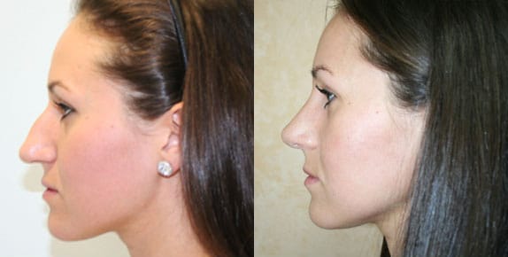 Rhinoplasty Before & After - Dr. Thomassen