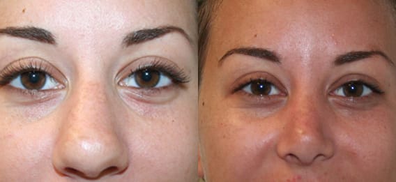 Rhinoplasty Before & After - Dr. Thomassen