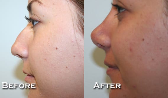 Rhinoplasty Before & After - Dr. Thomassen