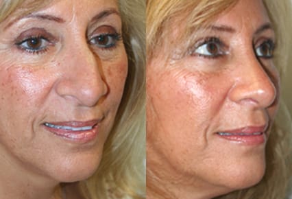 Rhinoplasty Before & After - Dr. Thomassen