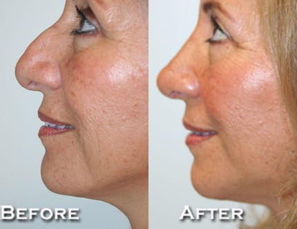 Rhinoplasty Before & After - Dr. Thomassen