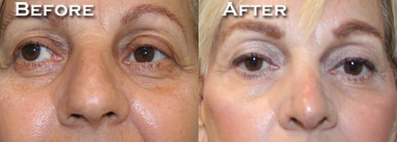 Rhinoplasty Before & After - Dr. Thomassen
