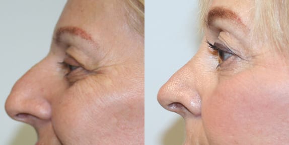 Rhinoplasty Before & After - Dr. Thomassen