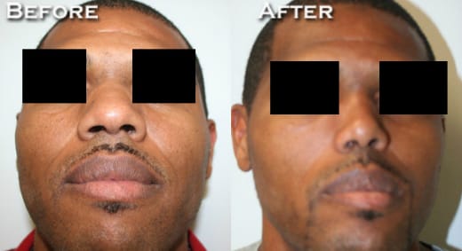 Rhinoplasty Before & After - Dr. Thomassen