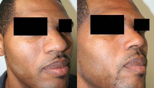 Rhinoplasty Before & After - Dr. Thomassen