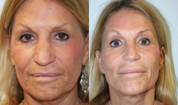 Rhinoplasty Before & After - Dr. Thomassen