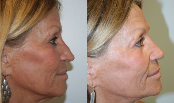 Rhinoplasty Before & After - Dr. Thomassen