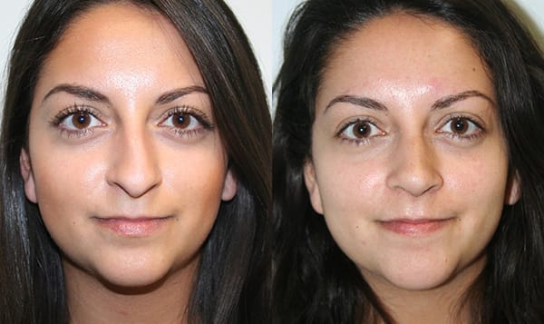 Rhinoplasty Before & After - Dr. Thomassen