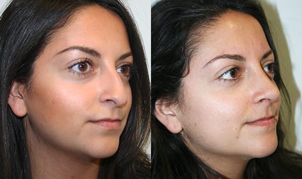 Rhinoplasty Before & After - Dr. Thomassen
