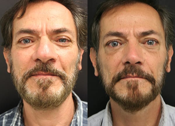 Rhinoplasty Before & After - Dr. Thomassen