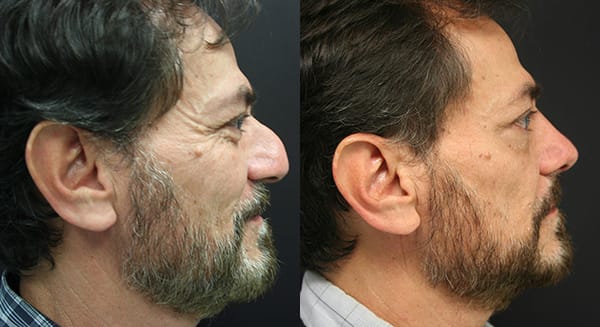 Rhinoplasty Before & After - Dr. Thomassen