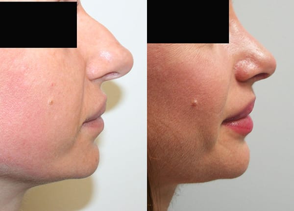 Rhinoplasty Before & After - Dr. Thomassen