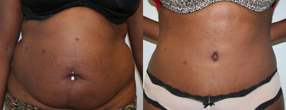 Tummy Tuck Before & After - Dr. Thomassen