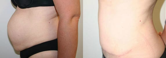 Tummy Tuck Before & After - Dr. Thomassen