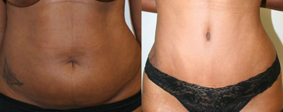 Tummy Tuck Before & After - Dr. Thomassen