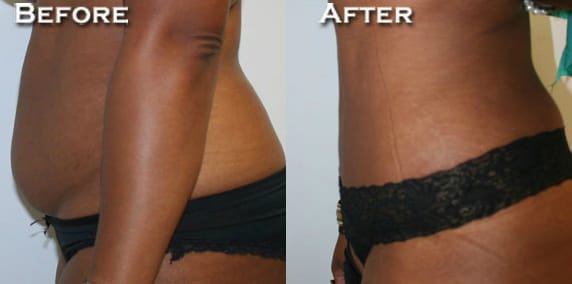 Tummy Tuck Before & After - Dr. Thomassen