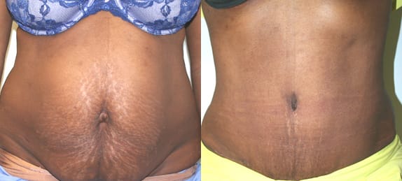 Tummy Tuck Before & After - Dr. Thomassen