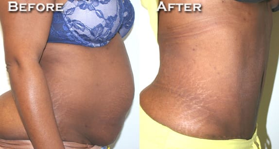 Tummy Tuck Before & After - Dr. Thomassen