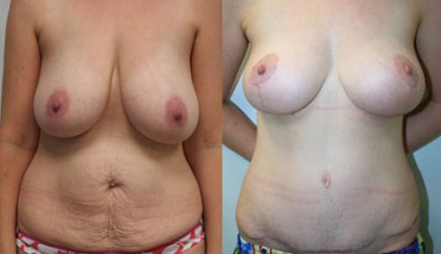 Tummy Tuck Before & After - Dr. Thomassen