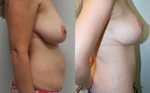 Tummy Tuck Before & After - Dr. Thomassen