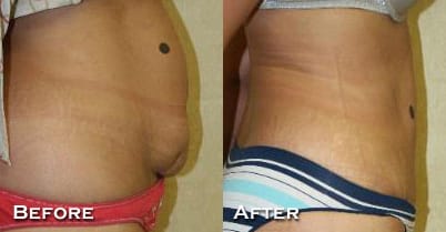 Tummy Tuck Before & After - Dr. Thomassen