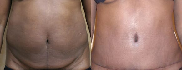 Tummy Tuck Before & After - Dr. Thomassen