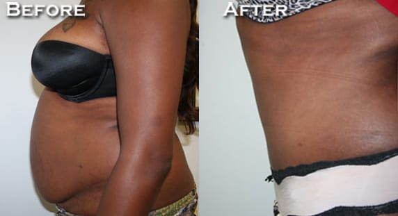 Tummy Tuck Before & After - Dr. Thomassen