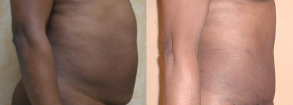 Tummy Tuck Before & After - Dr. Thomassen
