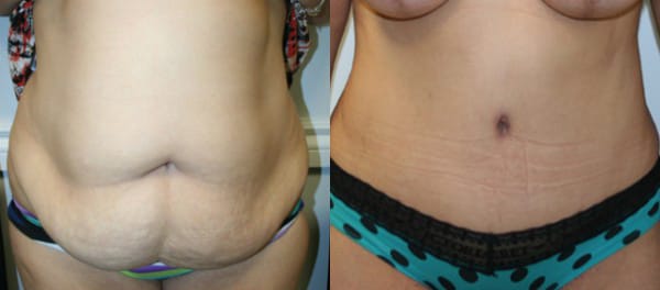 Tummy Tuck Before & After - Dr. Thomassen