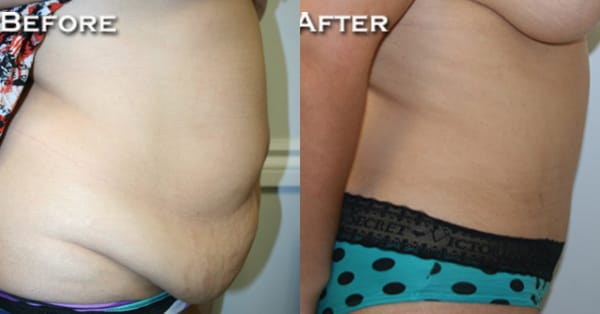 Tummy Tuck Before & After - Dr. Thomassen