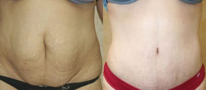 Tummy Tuck Before & After - Dr. Thomassen