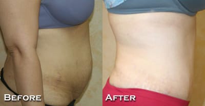 Tummy Tuck Before & After - Dr. Thomassen