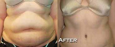 Tummy Tuck Before & After - Dr. Thomassen